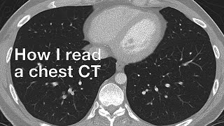 How I Read a Chest CT [upl. by Yelir]