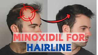 Minoxidil for Frontal Baldness  Restore Your Hairline [upl. by Kragh]