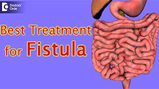 What is the best treatment for fistula  Dr Rajasekhar M R [upl. by Liamaj]