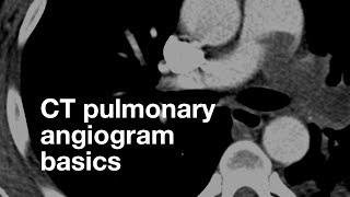 Pulmonary CT Angiogram Basics [upl. by Nelle5]