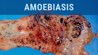 Amoebiasis  Pathology mini tutorial [upl. by Ocicnarf]