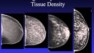 Introduction to Mammography [upl. by Absa]